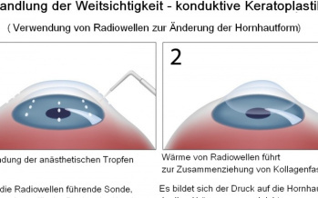 Behandlung der Weitsichtigkeit