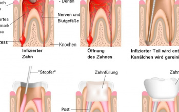 Behandlung des Zahnkanälchens