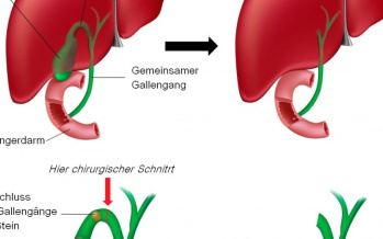 Gallenblasenentfernung - Cholezystektomie