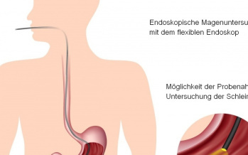 Gastroskopie