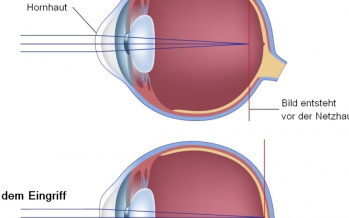 Laseroperation der Augen - LASIK