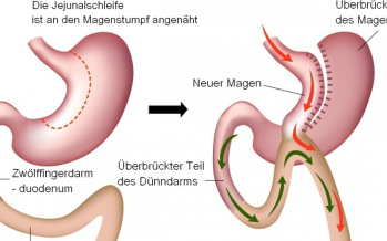 Mini-Magenbypass