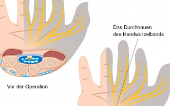 Operation des Karpaltunnels