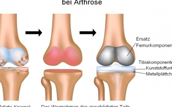 Totalendoprothese des Kniegelenks