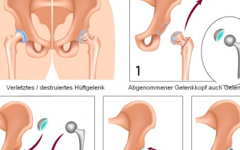 Totalendoprothese des Hüftgelenks