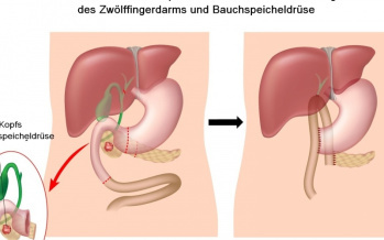 Whipple-Operation