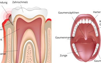 Zahnfleischentzündung