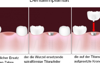 Zahnimplantat