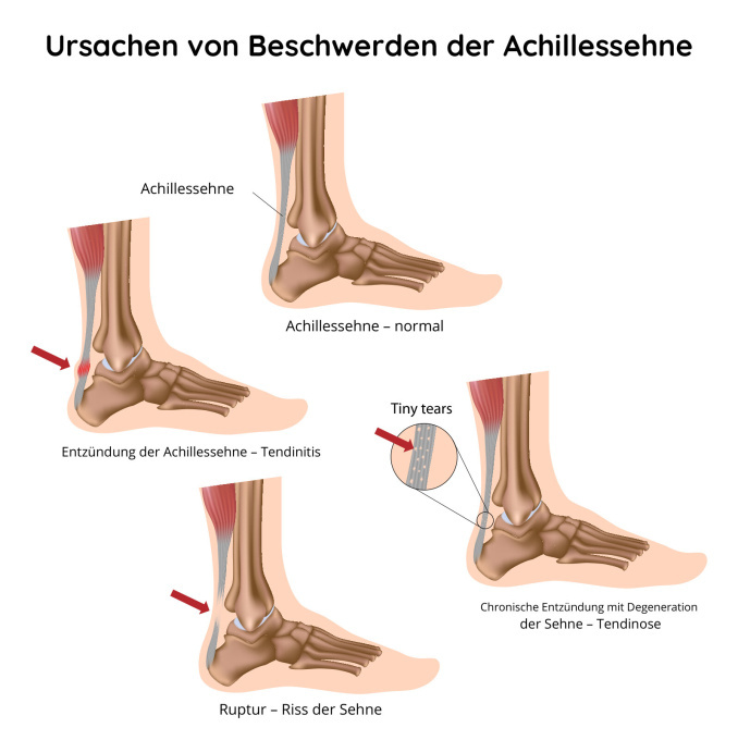 Ursachen von Beschwerden der Achillessehne