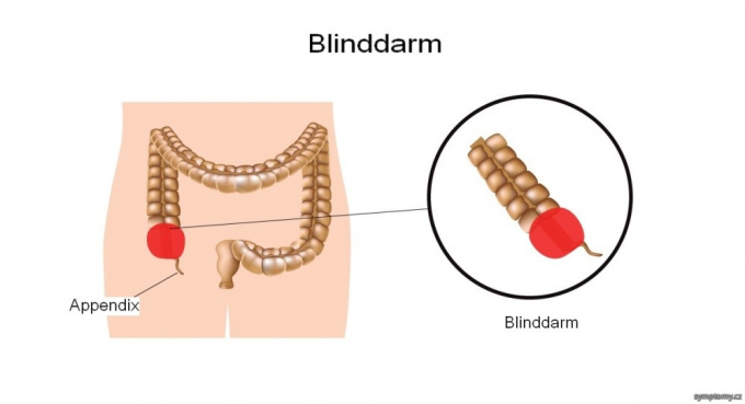 Blinddarm