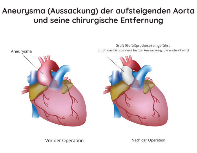 Aneurysma (Aussackung) der aufsteigenden Aorta und seine chirurgische Entfernung