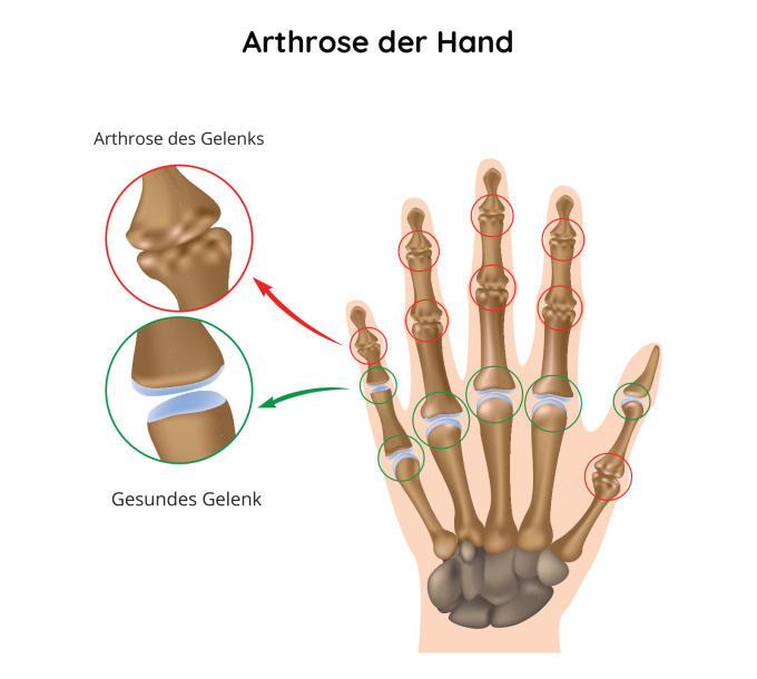 Arthrose der Hand