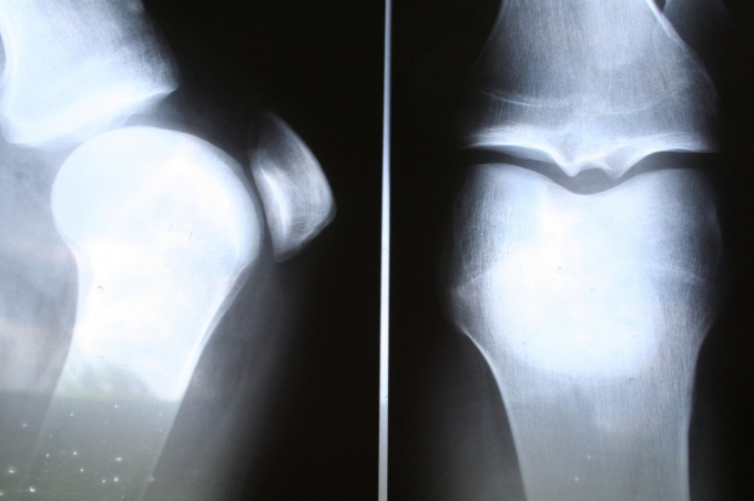 Arthrose-Röntgenbilder