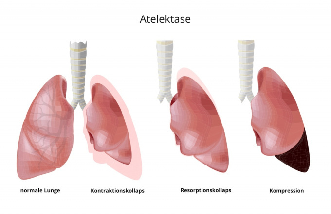 Atelektase