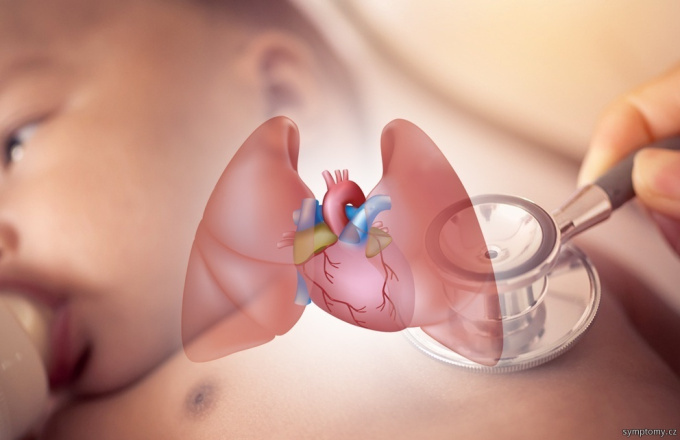 Bronchienentzündung bei Kindern