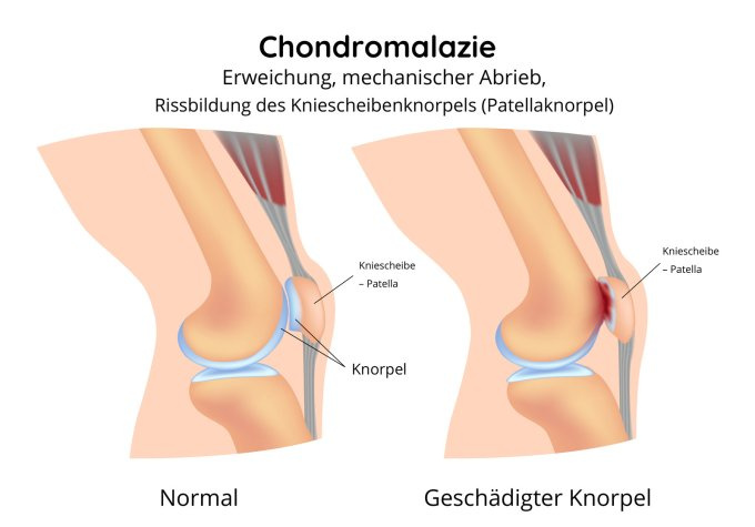 Chondromalazie