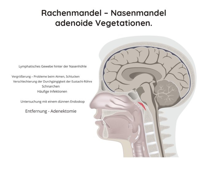 Rachenmandel – Nasenmandel adenoide Vegetationen.
