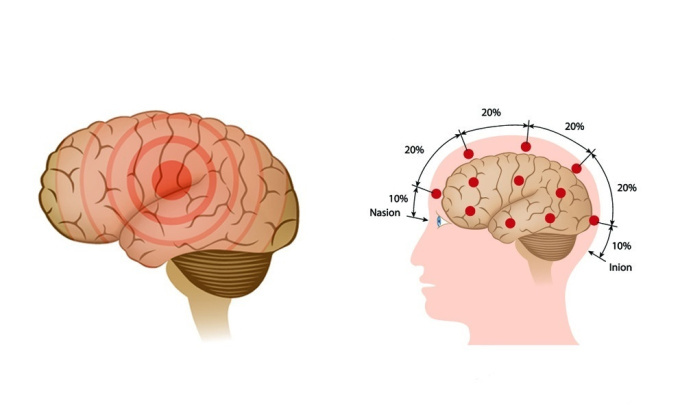 Epileptischer Anfall