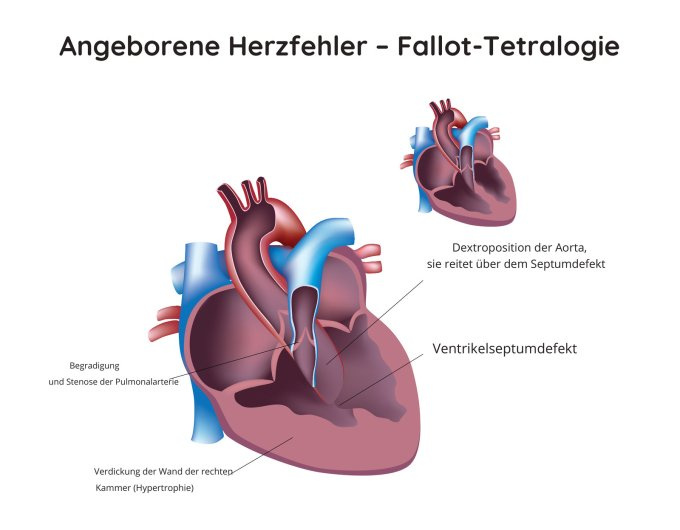 Angeborene Herzfehler – Fallot-Tetralogie