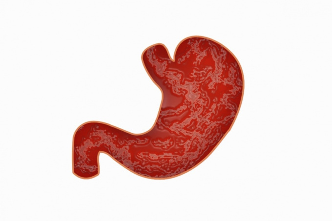 Gastritis - Magenschleimhautentzündung