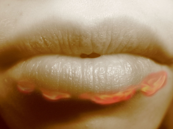 Lippenherpes