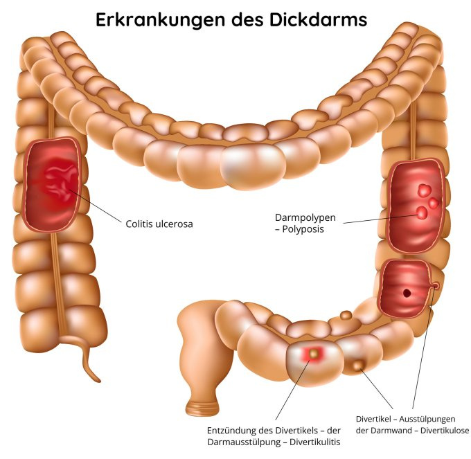 Krankheiten des Dickdarms