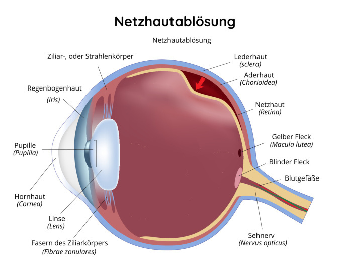 Netzhautablösung
