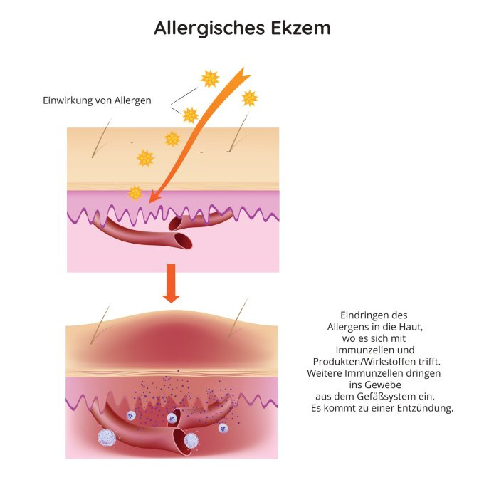 Verlauf der Bildung von allergischem Ekzem