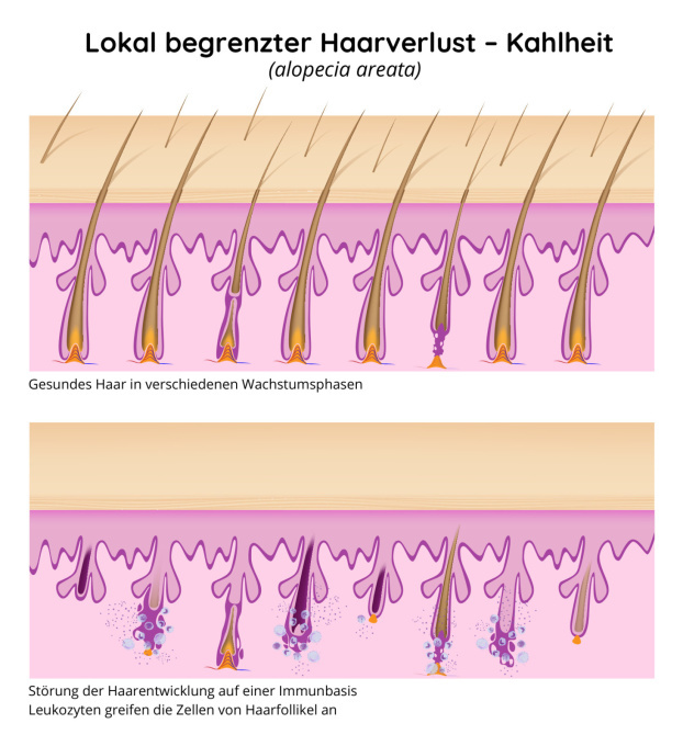 Begrenzter Haarverlust - Kahlheit, Alopezie, Haarausfall 