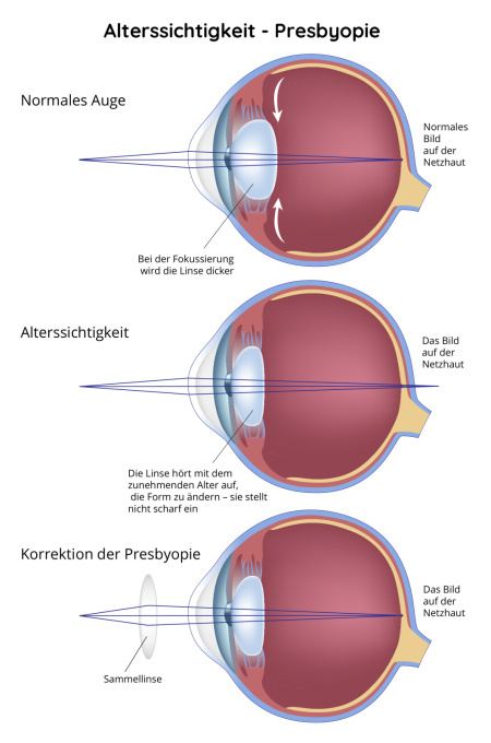 Alterssichtigkeit - Presbyopie