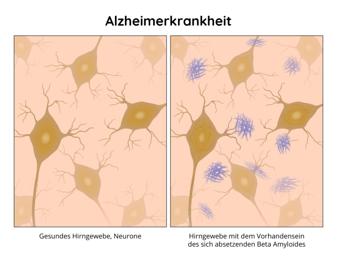 Alzheimer - Krankheit