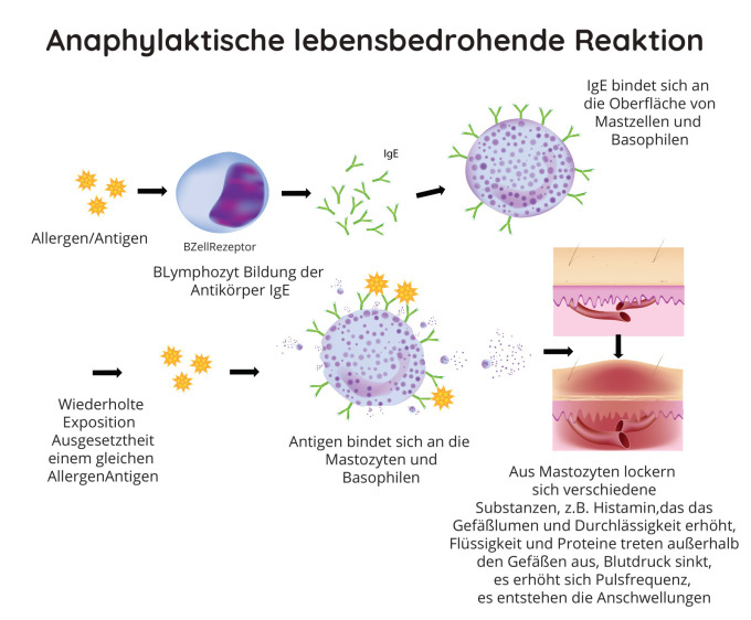 Die anaphylaktische lebensbedrohende Reaktion