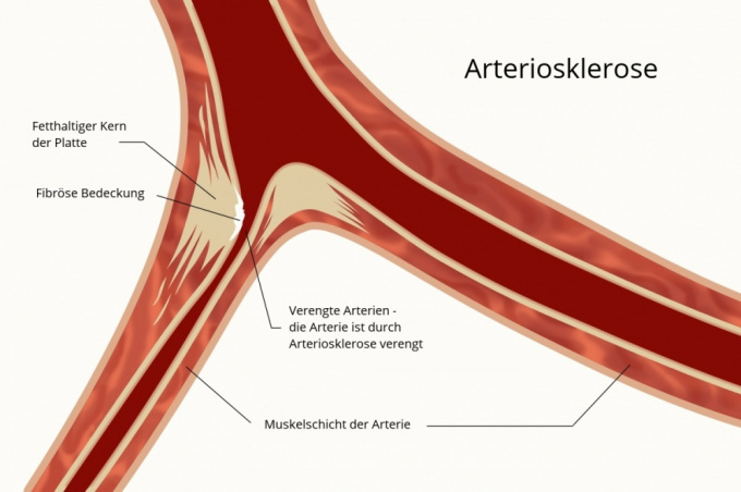 Arteriosklerose - Arterienverkalkung