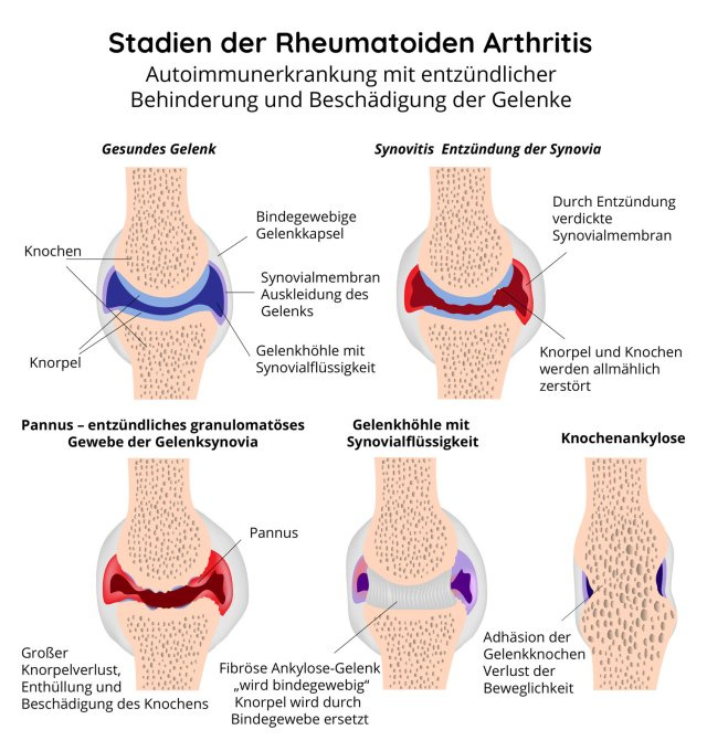 Stadien der rheumatoiden Arthritis