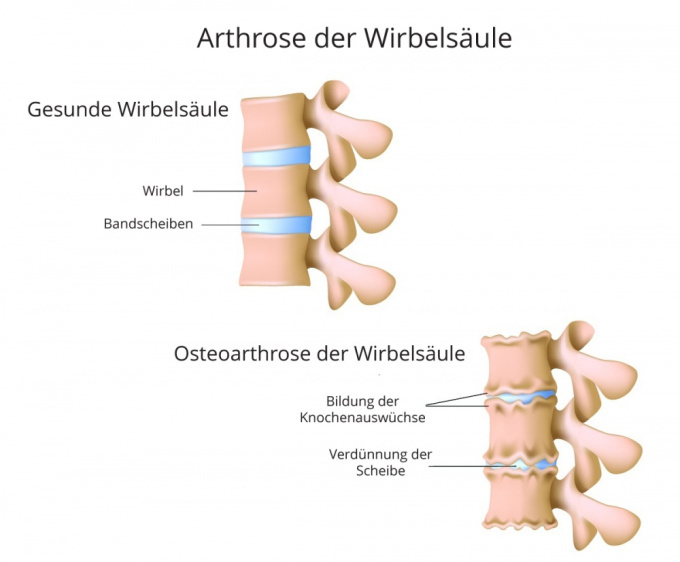 Osteoarthrose der Wirbelsäule