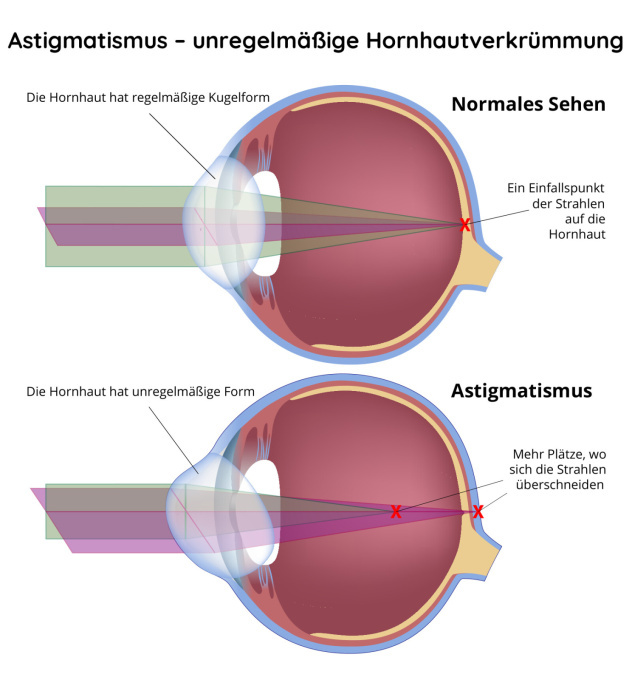 Astigmatismus - unregelmäßige Hornhautskrümmung