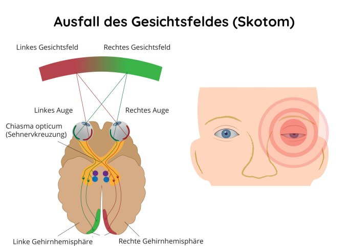 Skotom - Ausfall des Gesichtsfeldes