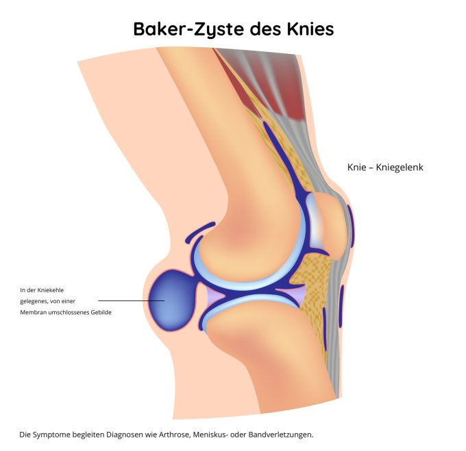 Baker-Zyste des Knies
