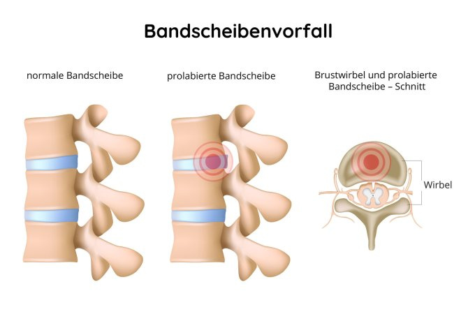 Prolabierte Bandscheibe
