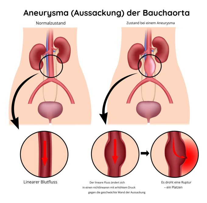 Aneurysma (Aussackung) der Bauchaorta