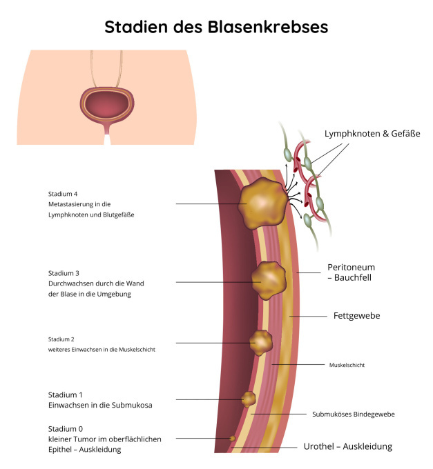 Stadien des Blasenkrebses