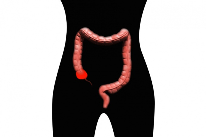 Appendizitis