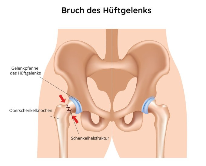 Bruch des Hüftgelenks