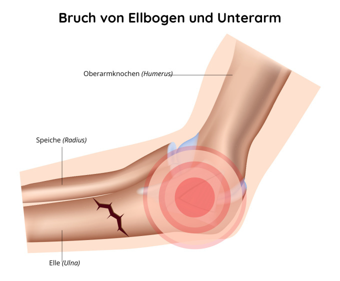 Bruch von Ellbogen und Unterarm