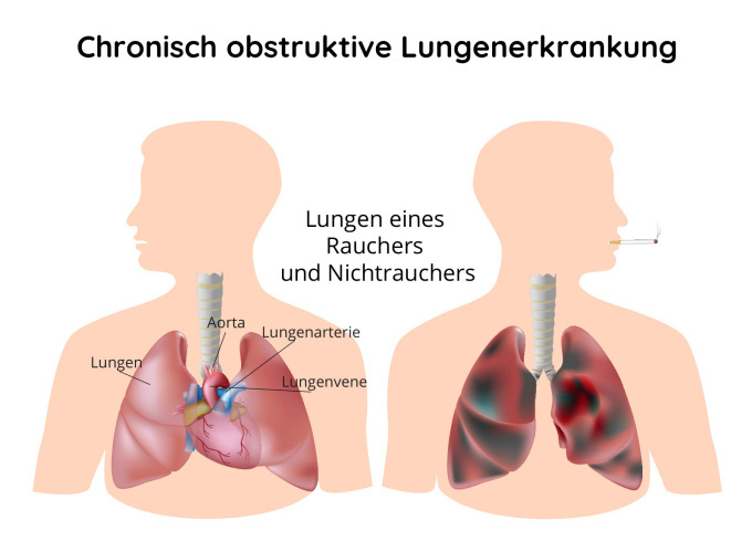 Chronische obstruktive bronchopulmonale Erkrankung - COPD