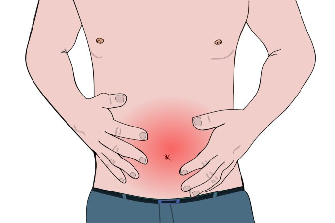 Colitis ulcerosa