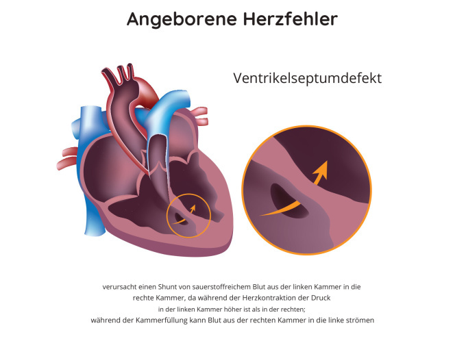 Angeborene Herzfehler