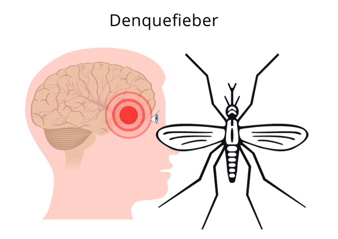 Denguefieber