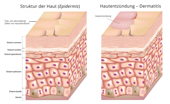 Dermatitis - schematische Darstellung