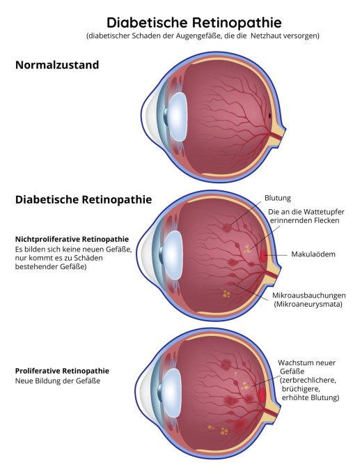 Diabetische Retinopathie